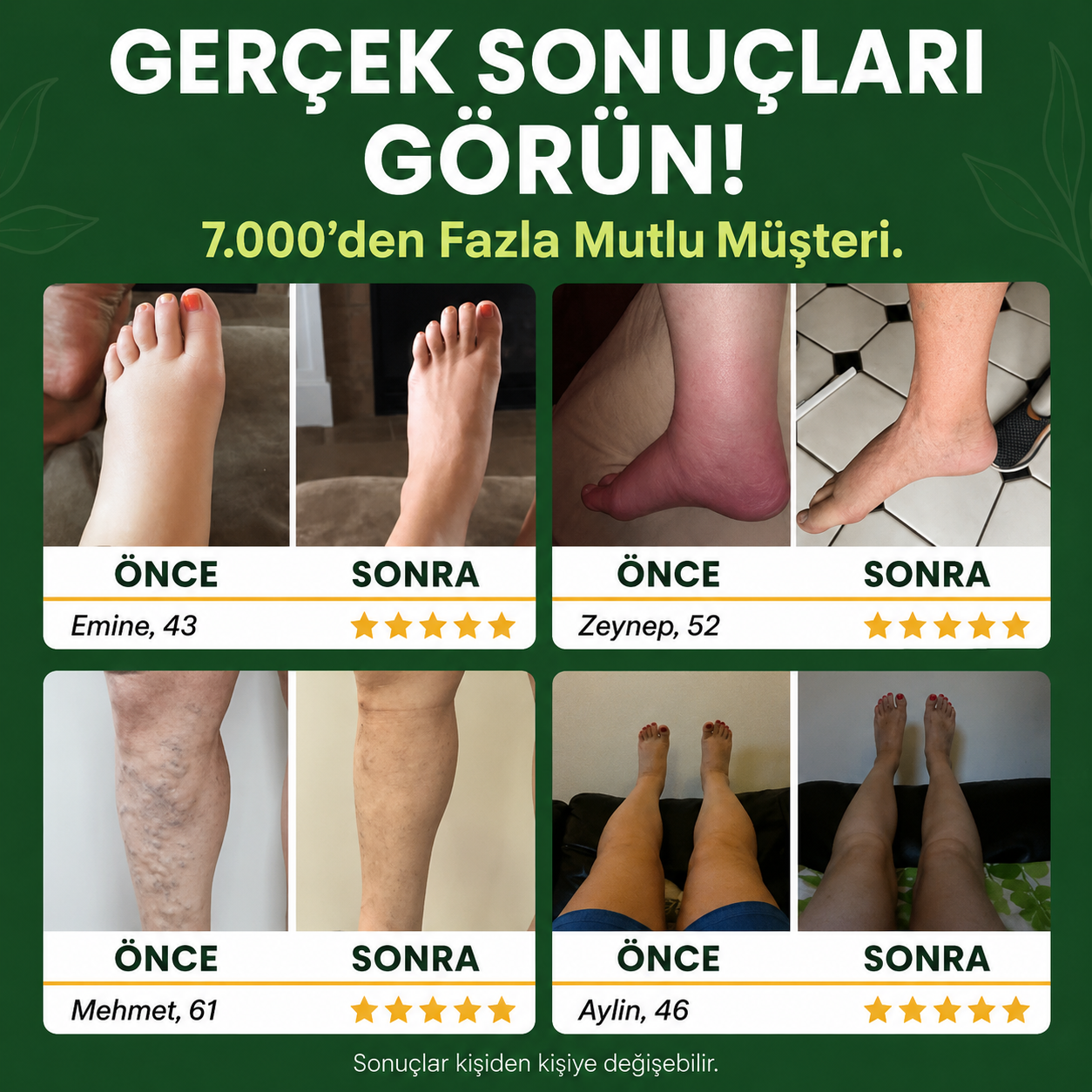 Sorviq Mucize Balsamı™ | Bitkisel Bacak Bakım Balsamı