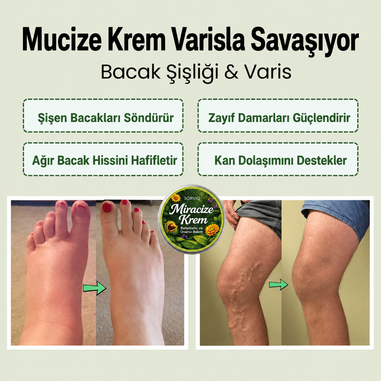Sorviq Mucize Balsamı™ | Bitkisel Bacak Bakım Balsamı